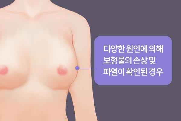 다양한 원인에 의해 보형물의 손상 및  파열이 확인된 경우