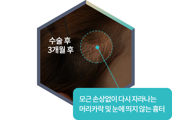 모근 손상없이 다시 자라나는 머리카락 및 눈에 띄지 않는 흉터 