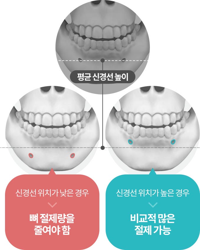 신경선 위치가 낮은 경우 신경선 위치가 낮은 경우 , 평균 신경선 높이 , 신경선 위치가 높은 경우 비교적 많은 절제 가능 