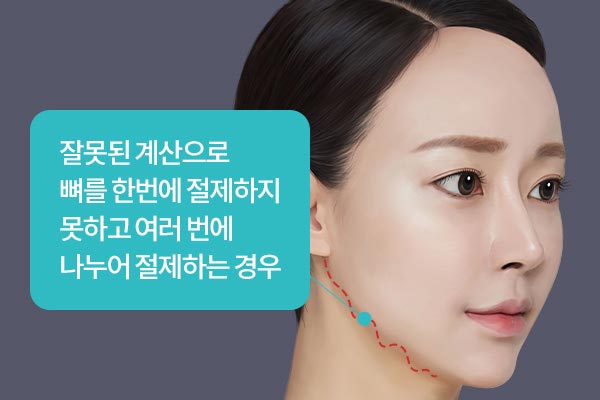 잘못된 계산으로 뼈를 한번에 절제하지 못하고 여러 번에 나누어 절제하는 경우