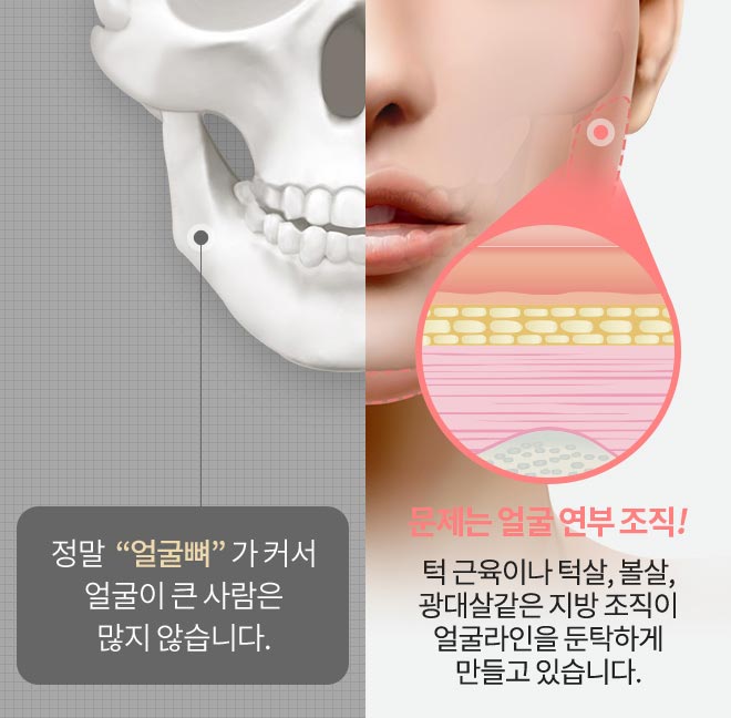 정말  “얼굴뼈” 가 커서 얼굴이 큰 사람은 많지 않습니다. 문제는 얼굴 연부 조직! 턱 근육이나 턱살, 볼살, 광대살같은 지방 조직이 얼굴라인을 둔탁하게 만들고 있습니다.