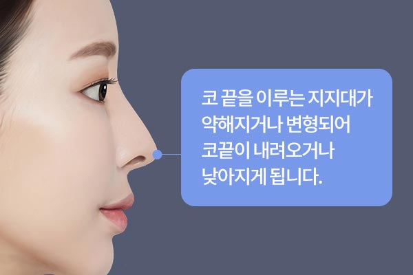 코 끝을 이루는 지지대가 약해지거나 변형되어 코끝이 내려오거나 낮아지게 됩니다.