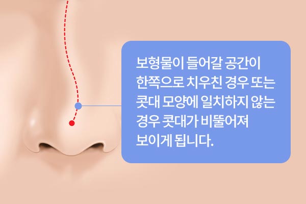 보형물이 들어갈 공간이 한쪽으로 치우친 경우 또는 콧대 모양에 일치하지 않는 경우 콧대가 비뚤어져 보이게 됩니다.