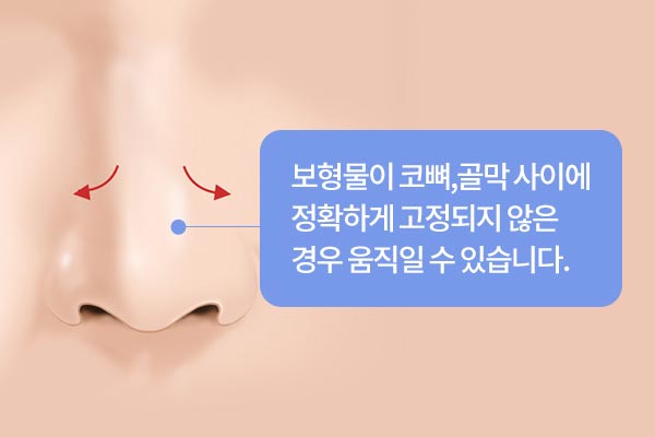 보형물이 코뼈,골막 사이에 정확하게 고정되지 않은 경우 움직일 수 있습니다.