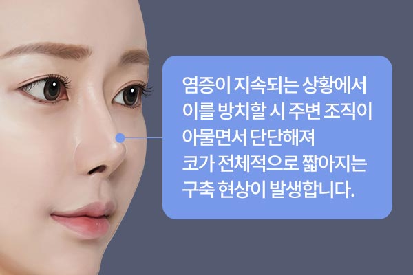 염증이 지속되는 상황에서  이를 방치할 시 주변 조직이 아물면서 단단해져  코가 전체적으로 짧아지는  구축 현상이 발생합니다.